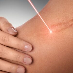 Curso en tratamiento avanzado de cicatrices